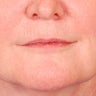CO2 Laser Resurfacing