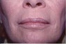 Laser Resurfacing