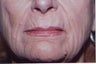 Laser Resurfacing