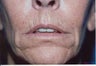 Laser Resurfacing