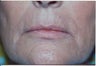 Laser Resurfacing