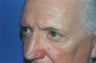 Laser Skin Resurfacing with Dr. Clevens