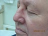 Laser vein treatment of veins on the nose