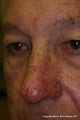 Varilite laser treatment of facial veins