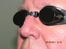 Laser vein treatment of veins on the nose