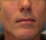 Smartpulse Laser