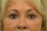 Upper and Lower Blepharoplasty