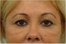 Upper and Lower Blepharoplasty