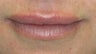 Lip Augmentation