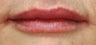 Lip Augmentation