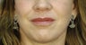 Lip Augmentation with fillers