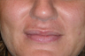 Lip enhancement in a young woman
