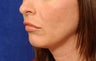 Before and After Lip Augmentation 