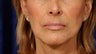 Before and After Lip Augmentation 