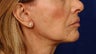 Before and After Lip Augmentation 