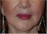 Lip augmentation with Restylane injections