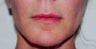 Lip Augmentation
