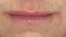 Lip Augmentation