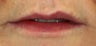 Lip Augmentation