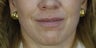 Lip Augmentation with fillers