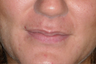 Lip enhancement in a young woman