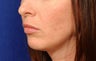 Before and After Lip Augmentation 