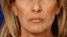 Before and After Lip Augmentation 