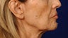 Before and After Lip Augmentation 