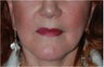 Lip augmentation with Restylane injections