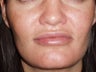 Lip Augmentations