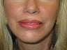 Lip Implant