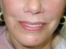 Lip Implant