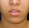 Lip Lift