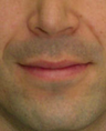 Lip Lift 