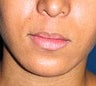 Lip Lift