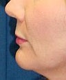 Lip Augmentation with lip lift