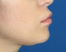 Lip Reduction