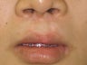 fati injection from abdomen to lip; dermabrasion to nostril scars