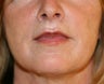 Lip Lift