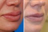Lip Reduction and Repair