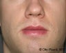 Lip Reduction 