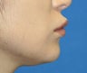 Lip Reduction