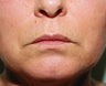 Anguloplasty