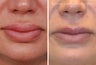 Lip Reduction and Repair
