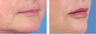 Lip Augmentation