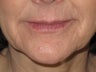 Lip Enhancement