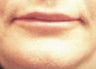 Lip Augmentation 