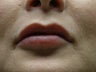 Lip Augmentation