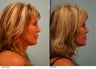 Lip Reduction for Correction of Silicone