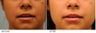 Lip Enhancement using Juvederm